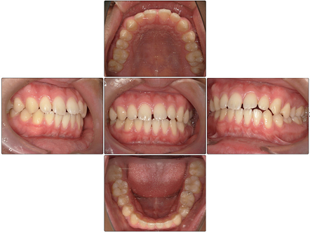 お口の中全体の写真Before