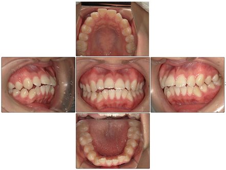 お口の中全体の写真Before