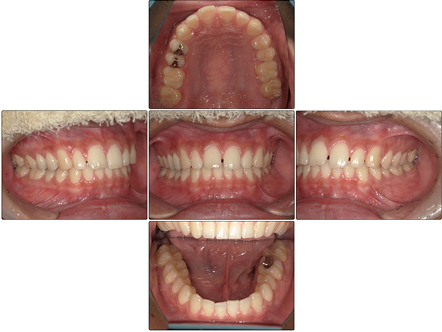 お口の中全体の写真Before