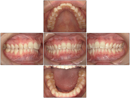 お口の中全体の写真Before