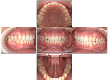 お口の中全体の写真After
