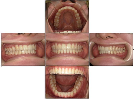 お口の中全体の写真After