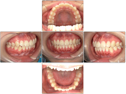 お口の中全体の写真After