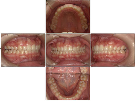 お口の中全体の写真After
