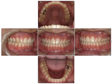 お口の中全体の写真After