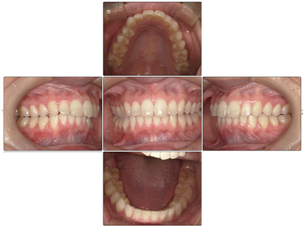 お口の中全体の写真After
